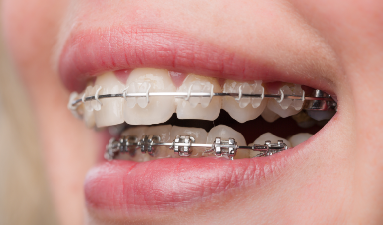If Orthodontic Treatment Fails Once, the Second Time Is More Difficult: What You Must Know Before Retreatment image 3