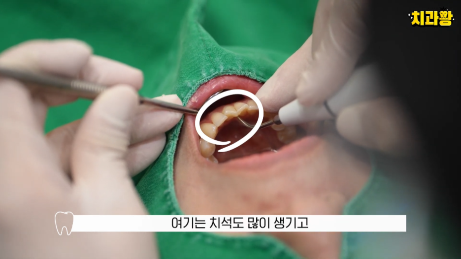 (피나는)잇몸 스케일링 방치하면 위험한 이유 관련 이미지 2