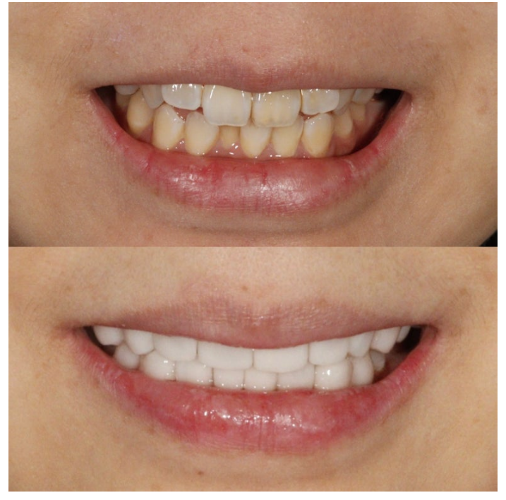 라미네이트부작용을 막는 3가지 비밀 - 대표원장 작성 관련 이미지 2