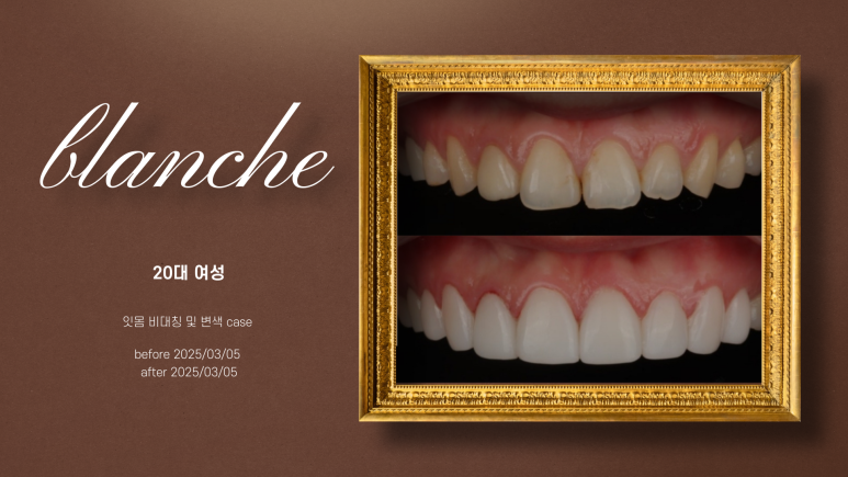 치아 고민별 블랑쉬 적합사례 총정리 관련 이미지 6