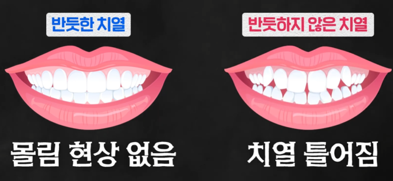 발치 없이 가능할까? 앞니 부분교정 전 반드시 체크해야 할 진단 포인트 관련 이미지 4