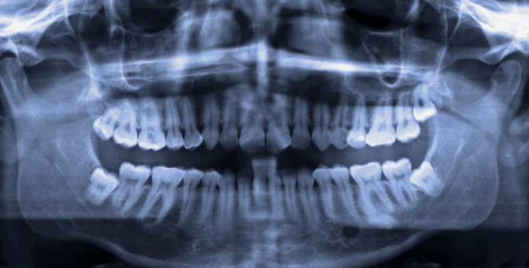 Impacted, Horizontally Positioned Wisdom Tooth Extraction: 3 Cases Where Extraction May Not Be Necessary image 3