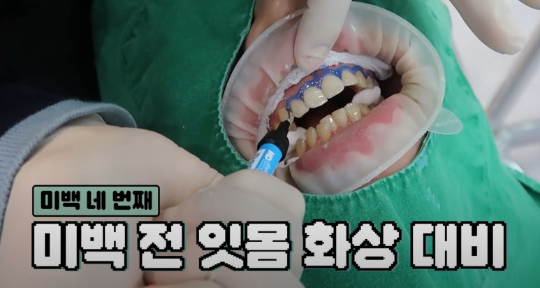 치아미백 시술,  시간과 가격 한계점까지 알려드립니다. 관련 이미지 6