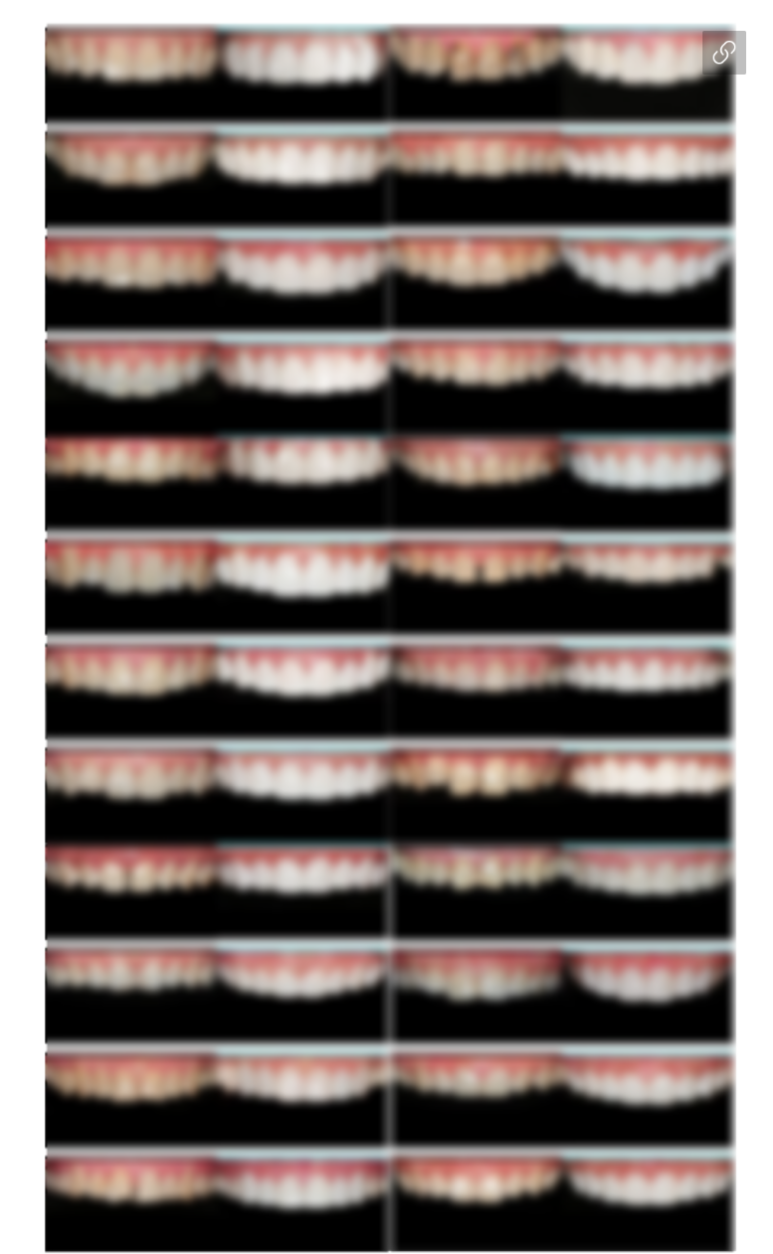 무삭제 라미네이트 vs 블랑쉬, 대표원장이 직접 알려주는 차이점 관련 이미지 32