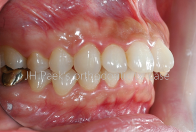 라미네이트부작용을 막는 3가지 비밀 - 대표원장 작성 관련 이미지 7