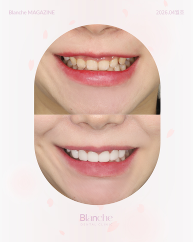 Worried About Gums Showing When You Smile? image 6