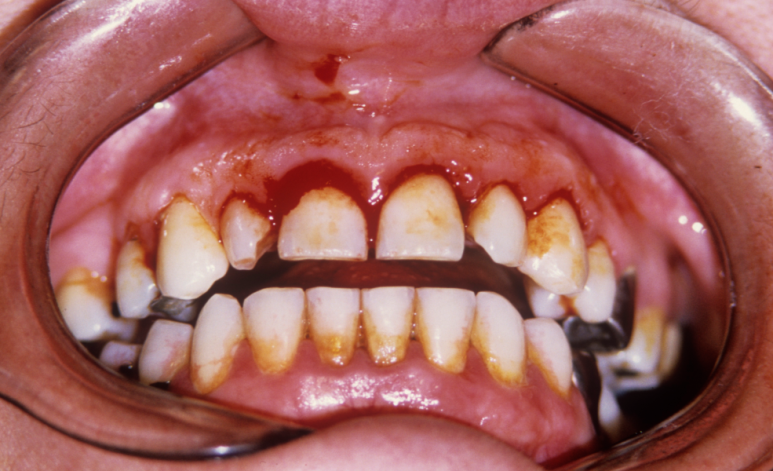 Why Painless Gum Bleeding Can Be More Dangerous — 3 Golden Opportunities to Act Before the Alveolar Bone Deteriorates image 2