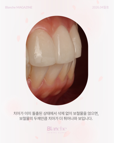 무삭제 라미네이트? 누구나 할 수 없는 진짜 이유 관련 이미지 5