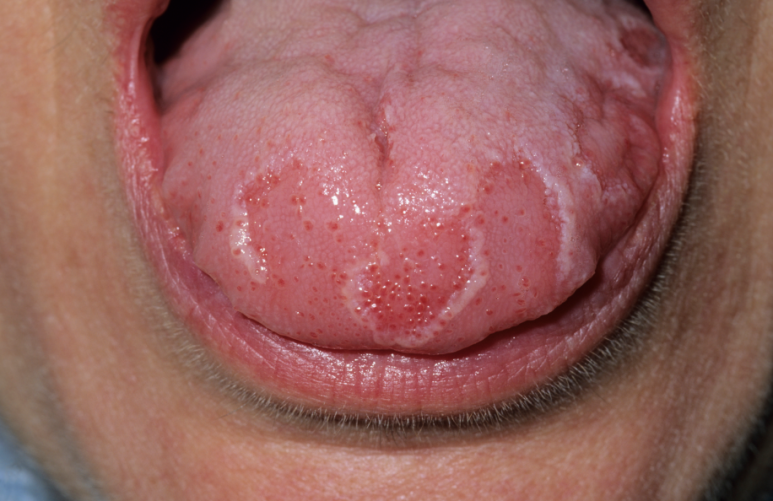 Tongue Tip Pain and Tongue Root Pain: Dentists Suspect Different Causes Depending on the Location image 2
