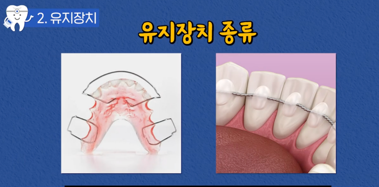 압구정치과 치아교정이 고민이라면 필독 관련 이미지 12