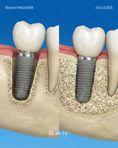 "임플란트 뼈이식, 무조건 해야 하나요?" 과잉진료 피하는 법 관련 이미지 7