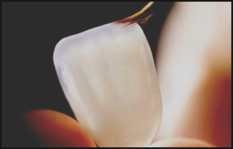 내근처치과 라미네이트 잘하는곳 찾는 기준 관련 이미지 5