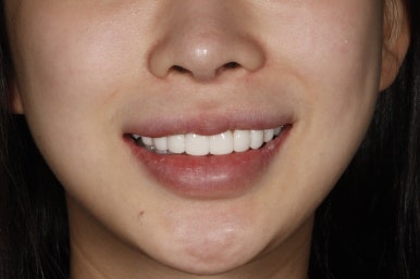 [블랑쉬치과] 치아 교정하고 난 후에 블랑쉬 가능할까요? 관련 이미지 7