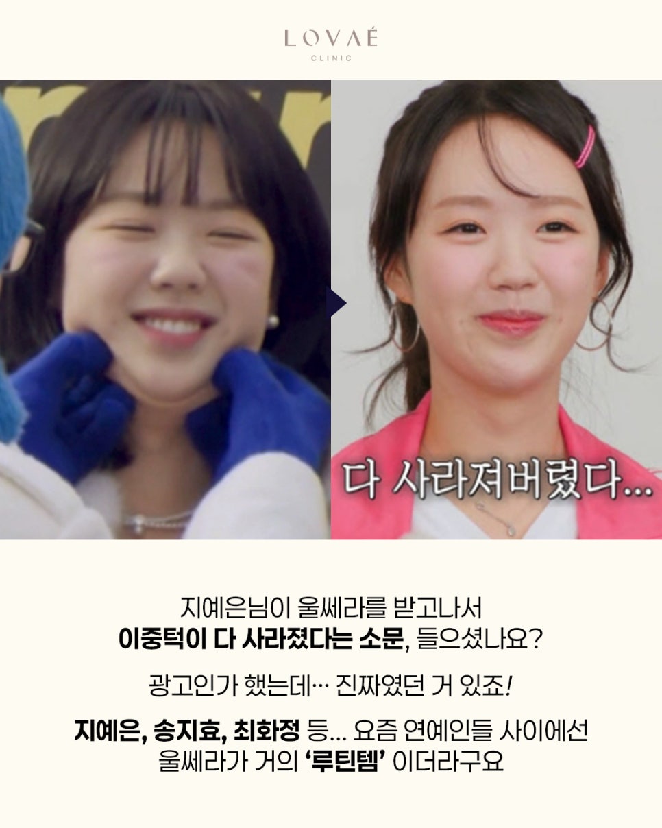 Ji Ye-eun Ulthera Effect? Is Ulthera Worth It for People in Their 20s? | Lobae Clinic, Hongdae Dermatology image 2