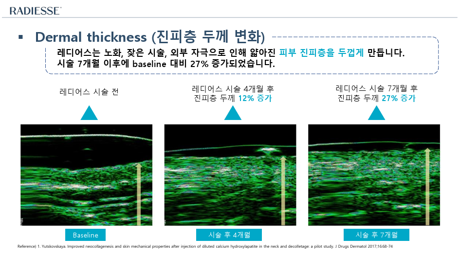 로바에의원) 콜라겐, 콜라겐..대체 뭐길래? 이렇게나 피부에 중요한 이유_홍대 레디어스 효과 관련 이미지 9