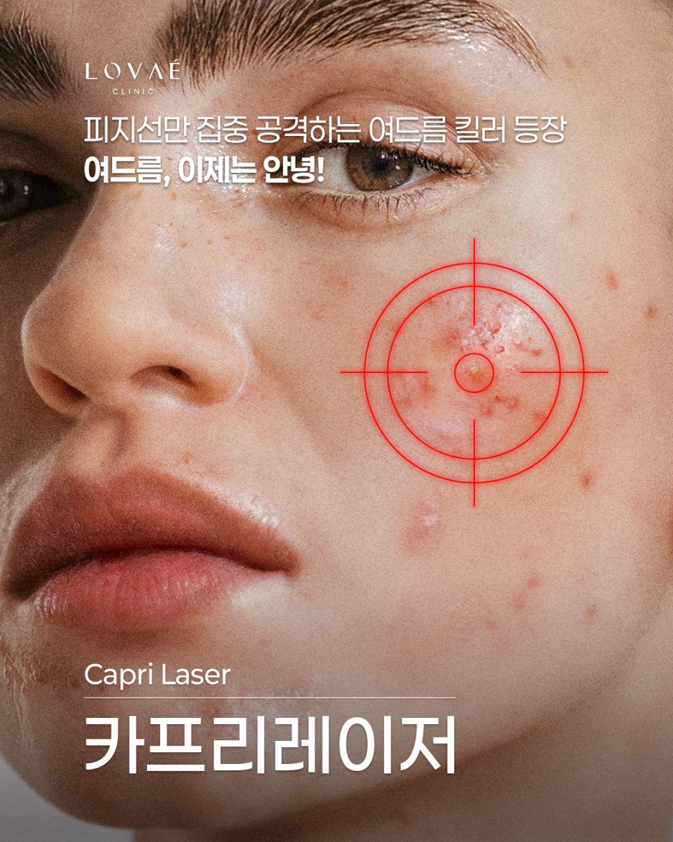 여드름 치료 카프리레이저 잘하는 곳 | 로바에의원 홍대 관련 이미지 1