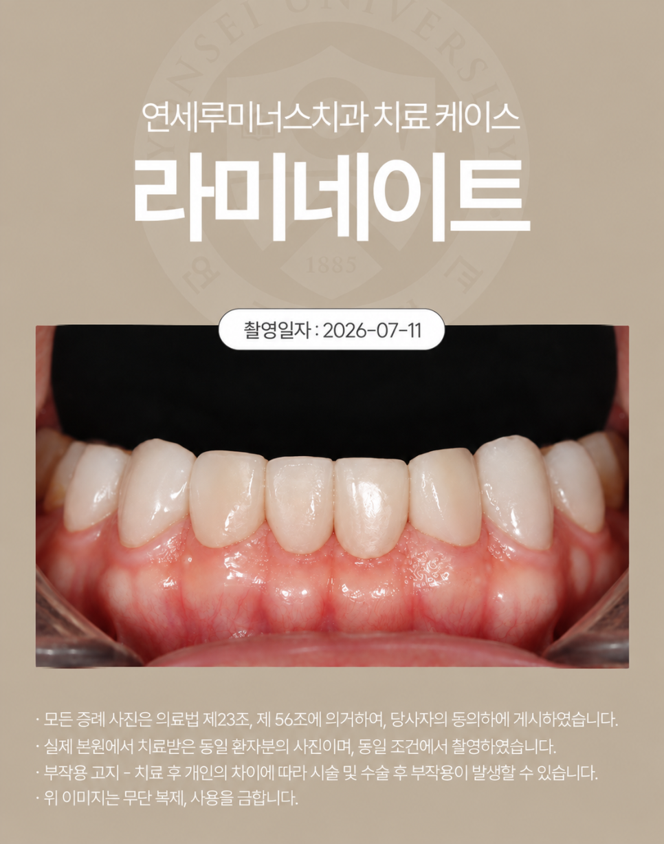 심하게 마모된 치아, 라미네이트로 회복할 수 있을까? 관련 이미지 5
