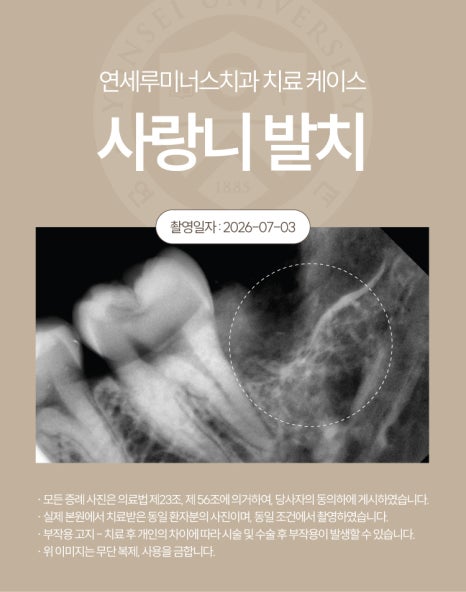 강남역사랑니발치 치료사례 ― 베트남 환자, 응급 내원 매복 사랑니 발치 케이스(10분 내 분할 발치 완료) 관련 이미지 4