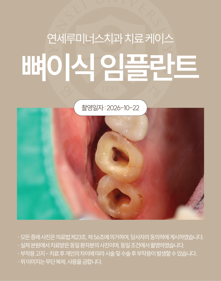 강남신경치료 케이스 : 사랑니까지 살린 17, 18번 치근단염 치료 (터키에서 오신 외국인 환자분!) 관련 이미지 6
