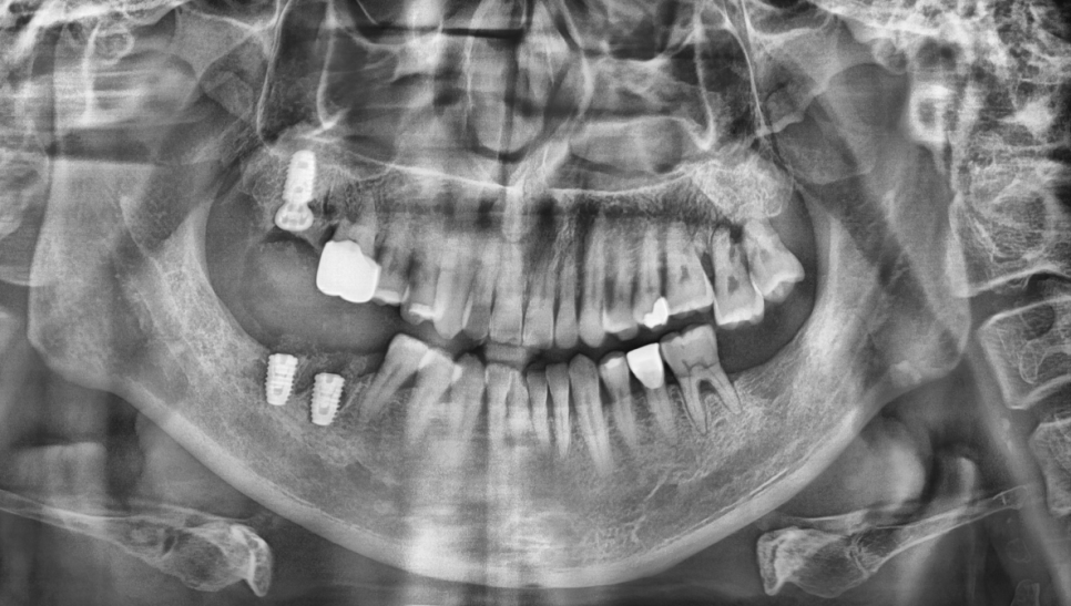 이전에 수술했던 임플란트 케이스 공유합니다! 관련 이미지 3