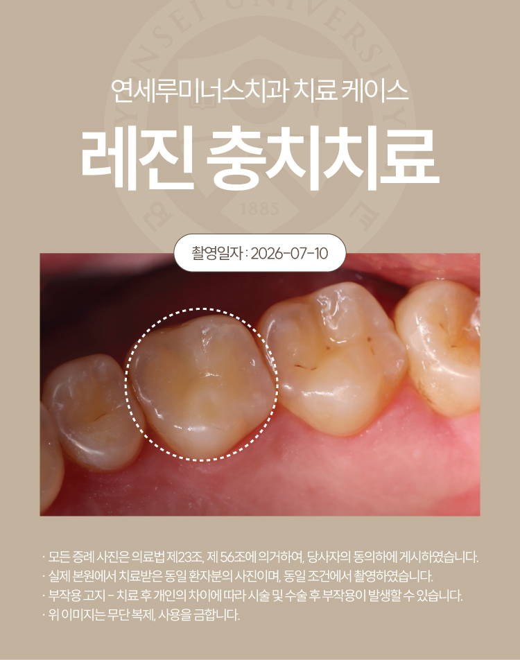 강남충치치료 사례 ― 충치 레진 충전 케이스 (37세/여환자/호주 외국인) 관련 이미지 4