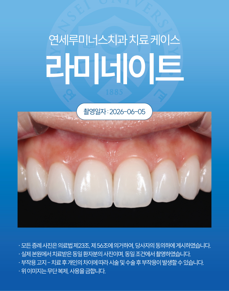 강남라미네이트 수복증례 ― 치아 표면의 석회화 반점 관련 이미지 3