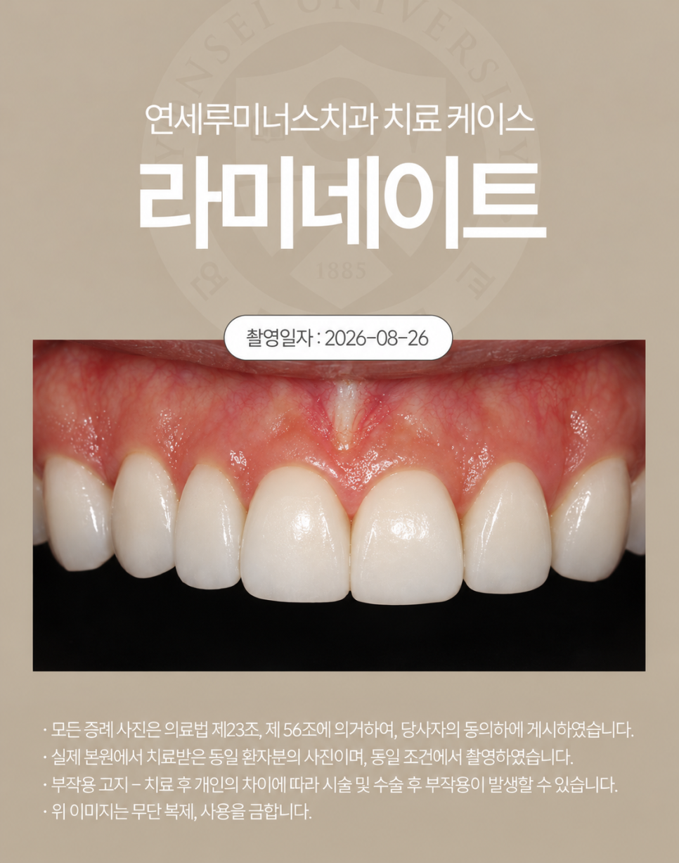 강남라미네이트 / 작고 어두운 치아, 자연스럽게 개선한 사례 관련 이미지 3