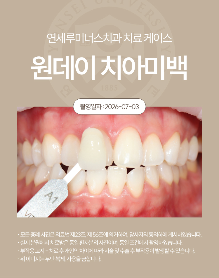 강남역원데이치아미백 치료사례 ― 원데이 치아미백 케이스 (27세/여환자) 관련 이미지 3
