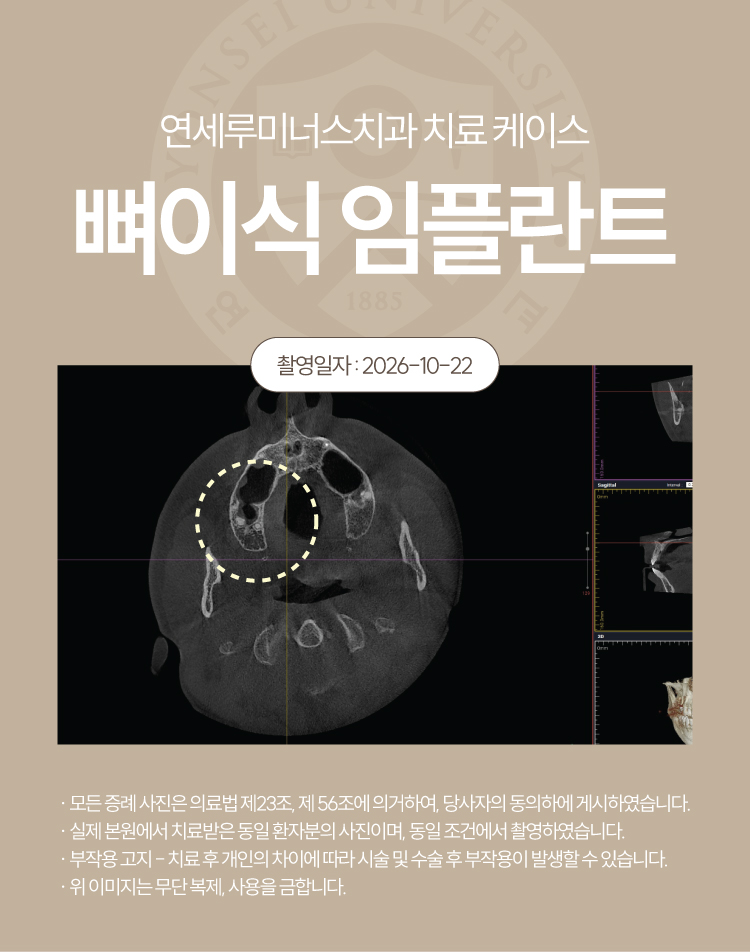 강남신경치료 케이스 : 사랑니까지 살린 17, 18번 치근단염 치료 (터키에서 오신 외국인 환자분!) 관련 이미지 3