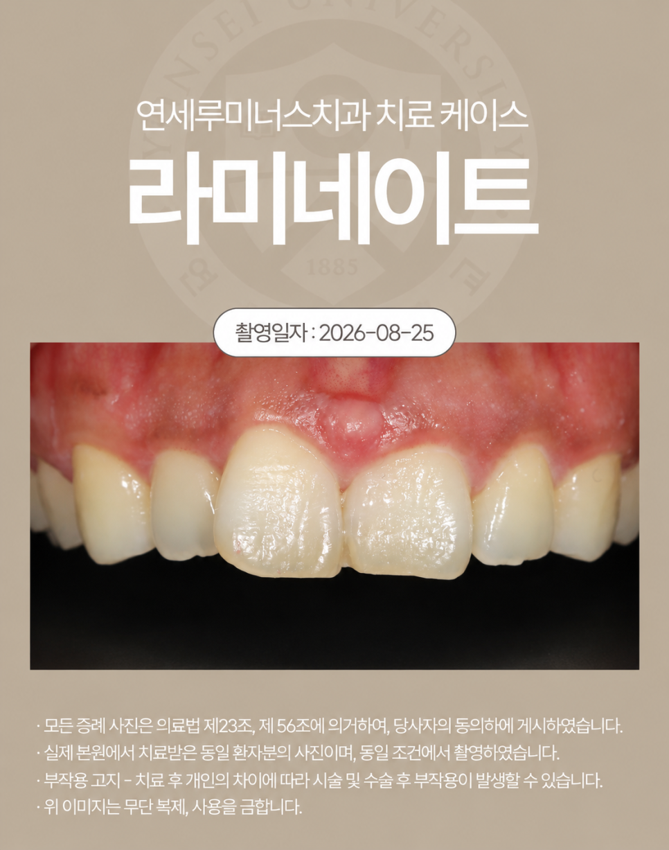강남라미네이트 / 삐뚤어진 치아도 깔끔하게 변신! 관련 이미지 2