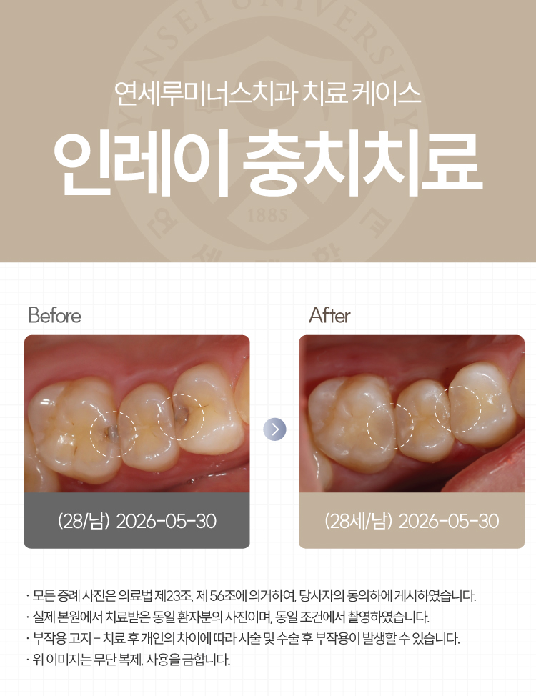강남충치치료 사례 ― 좌측 어금니 통증으로 발견(28세/남환자) 관련 이미지 1