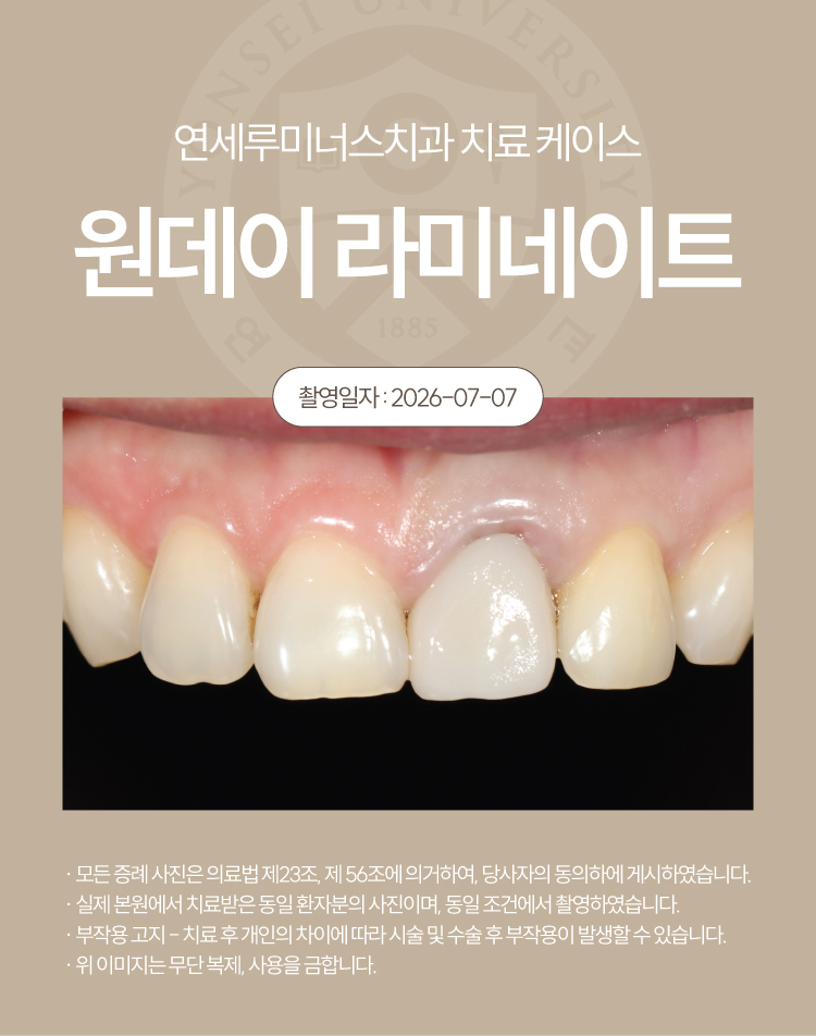 강남라미네이트 치료사례 ― 강원도 원주에서 찾아오신 라미네이트 + 2차충치 관련 이미지 3