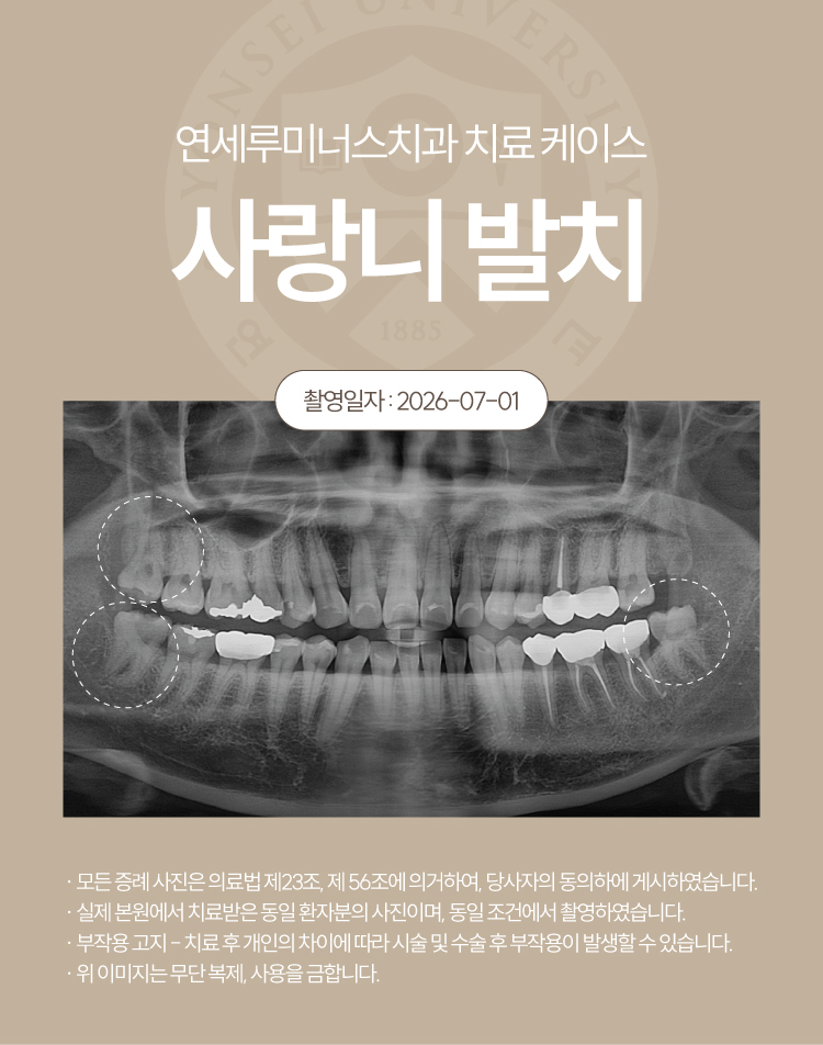 Gangnam Station Wisdom Tooth Extraction Case ― Simultaneous Extraction of Three Wisdom Teeth (21-Year-Old Female Patient) image 2