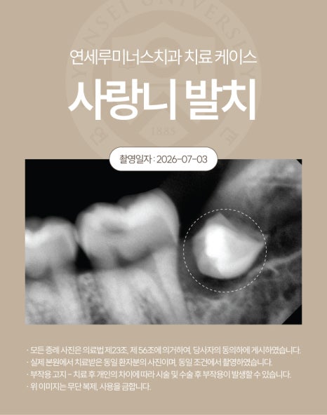 강남역사랑니발치 치료사례 ― 베트남 환자, 응급 내원 매복 사랑니 발치 케이스(10분 내 분할 발치 완료) 관련 이미지 3
