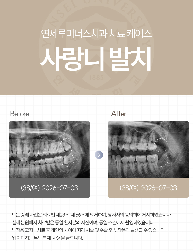 강남역사랑니발치 치료사례 ― 베트남 환자, 응급 내원 매복 사랑니 발치 케이스(10분 내 분할 발치 완료) 관련 이미지 1