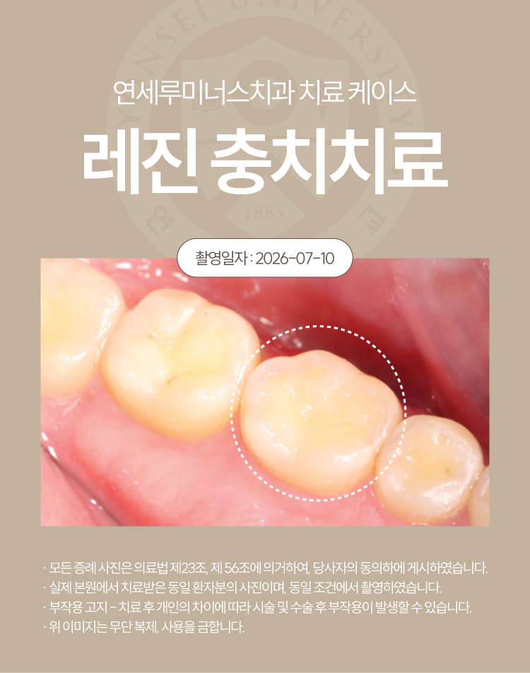 강남충치치료 사례 ― 충치 레진 충전 케이스 (37세/여환자/호주 외국인) 관련 이미지 6