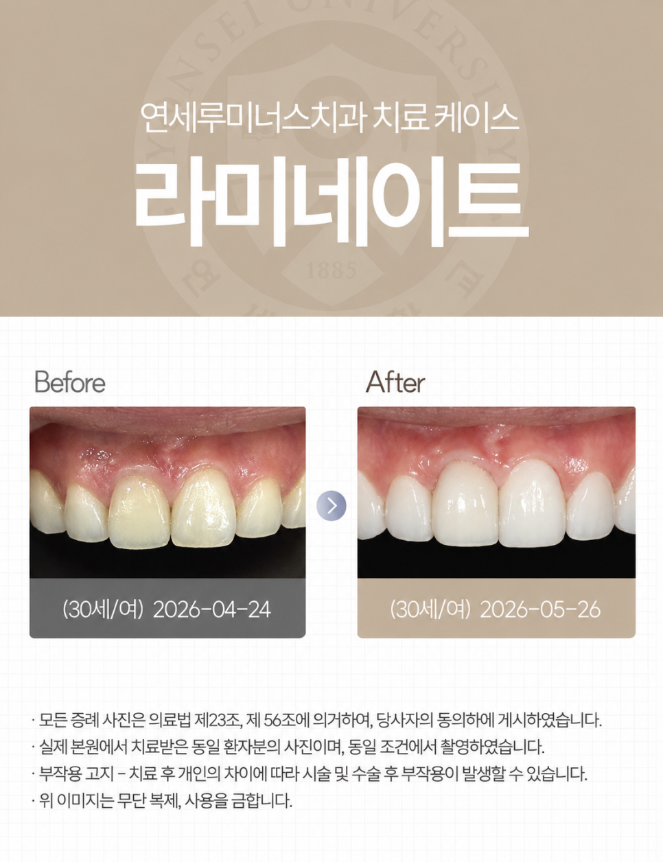 강남라미네이트 치료사례 - 색상, 라인개선 (30세/여) 관련 이미지 1