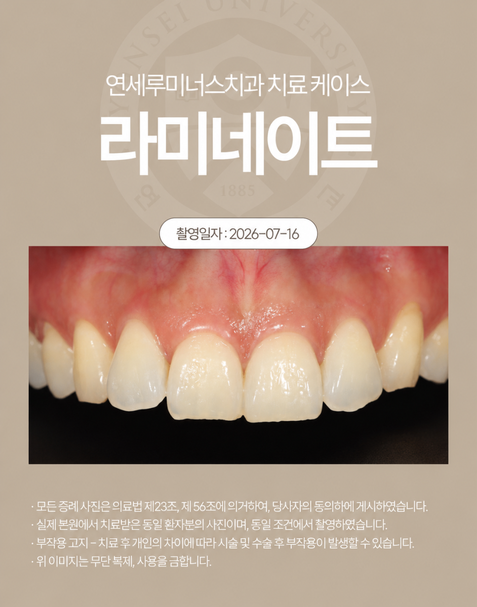 강남라미네이트 / 치아의 손상은 줄이고, 자연스러움은 더하는 방법 관련 이미지 2