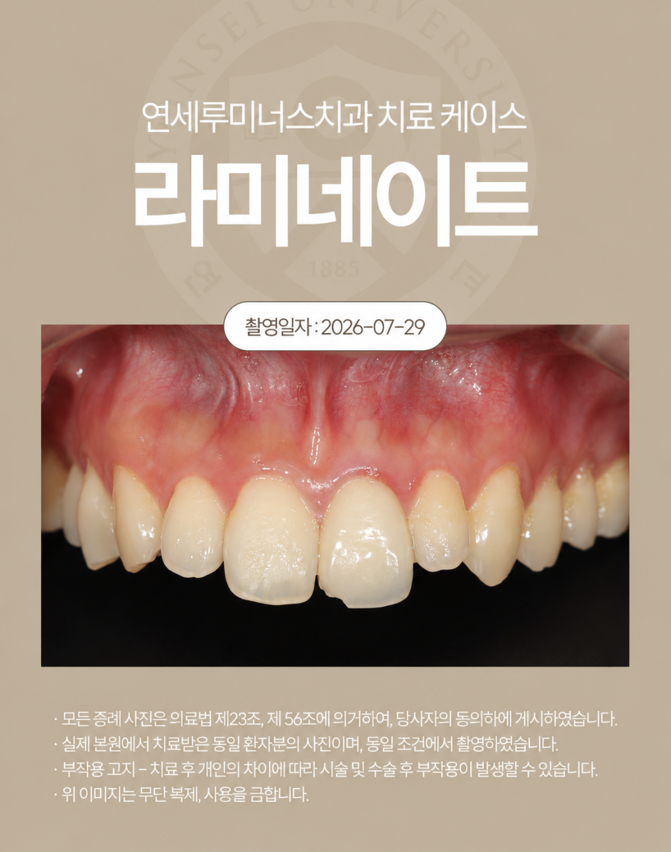 강남 라미네이트 / 깨진 앞니 고민을 자연스럽게 개선한 사례 관련 이미지 2
