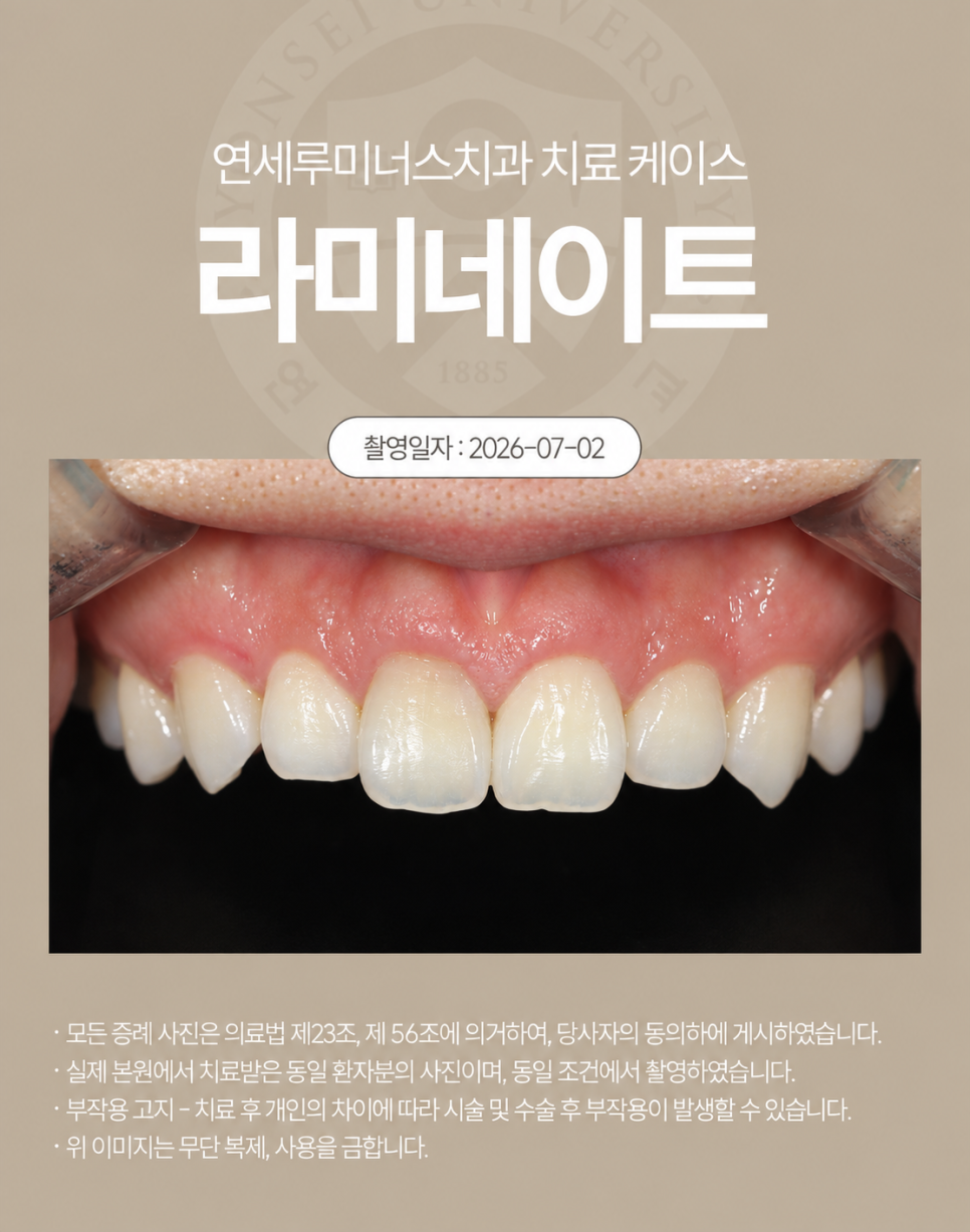 강남라미네이트 / 치아의 작은 디테일까지 고려한 심미 라미네이트 관련 이미지 2