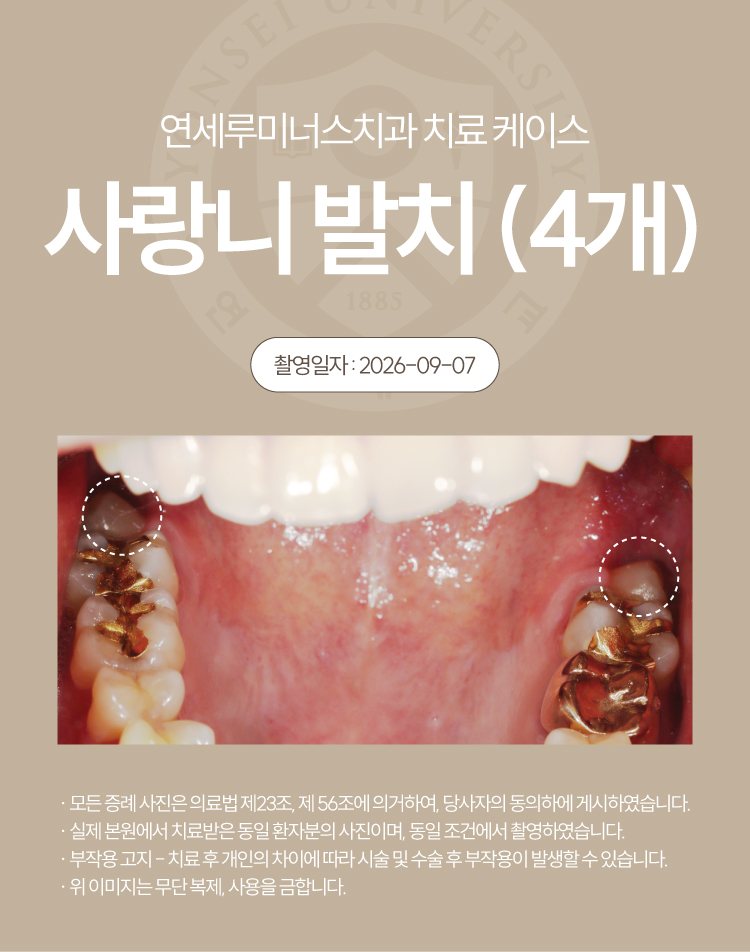 강남역사랑니발치, 4개 하루 만에 동시 발치 가능할까요? 관련 이미지 2