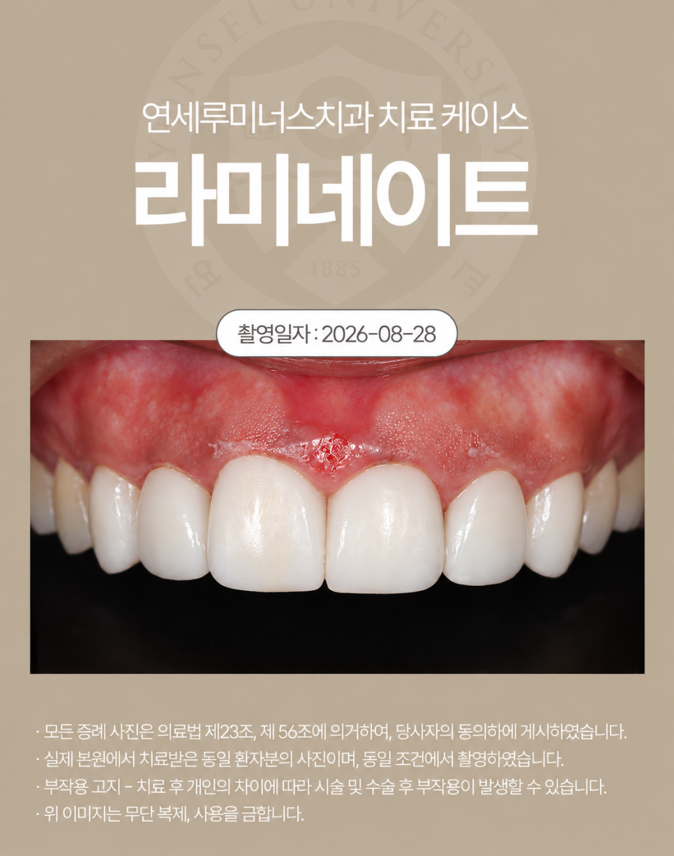 강남라미네이트 / 삐뚤어진 치아도 깔끔하게 변신! 관련 이미지 3