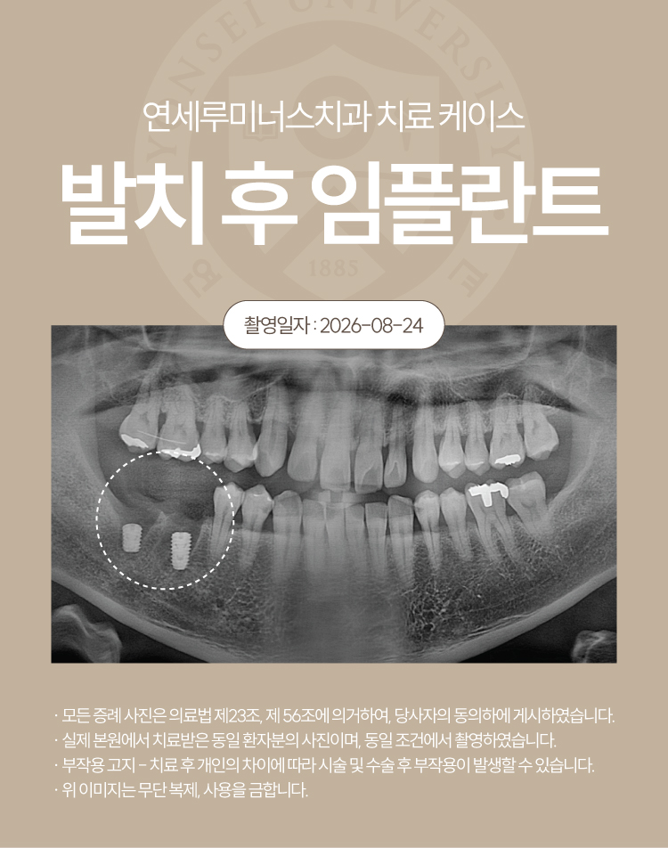 강남발치후임플란트 케이스 - 심한 치주질환으로 인한 발치 후 즉시 임플란트 (40대/남환자) 관련 이미지 6