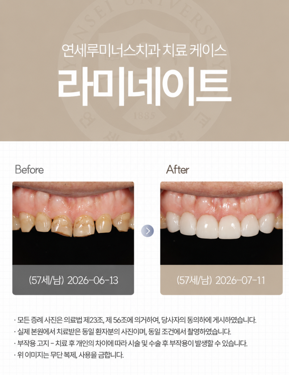 심하게 마모된 치아, 라미네이트로 회복할 수 있을까? 관련 이미지 1