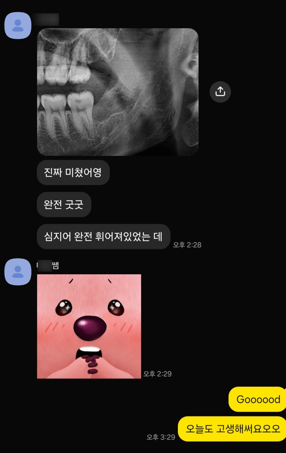 강남역사랑니발치 치료사례 ― 베트남 환자, 응급 내원 매복 사랑니 발치 케이스(10분 내 분할 발치 완료) 관련 이미지 7