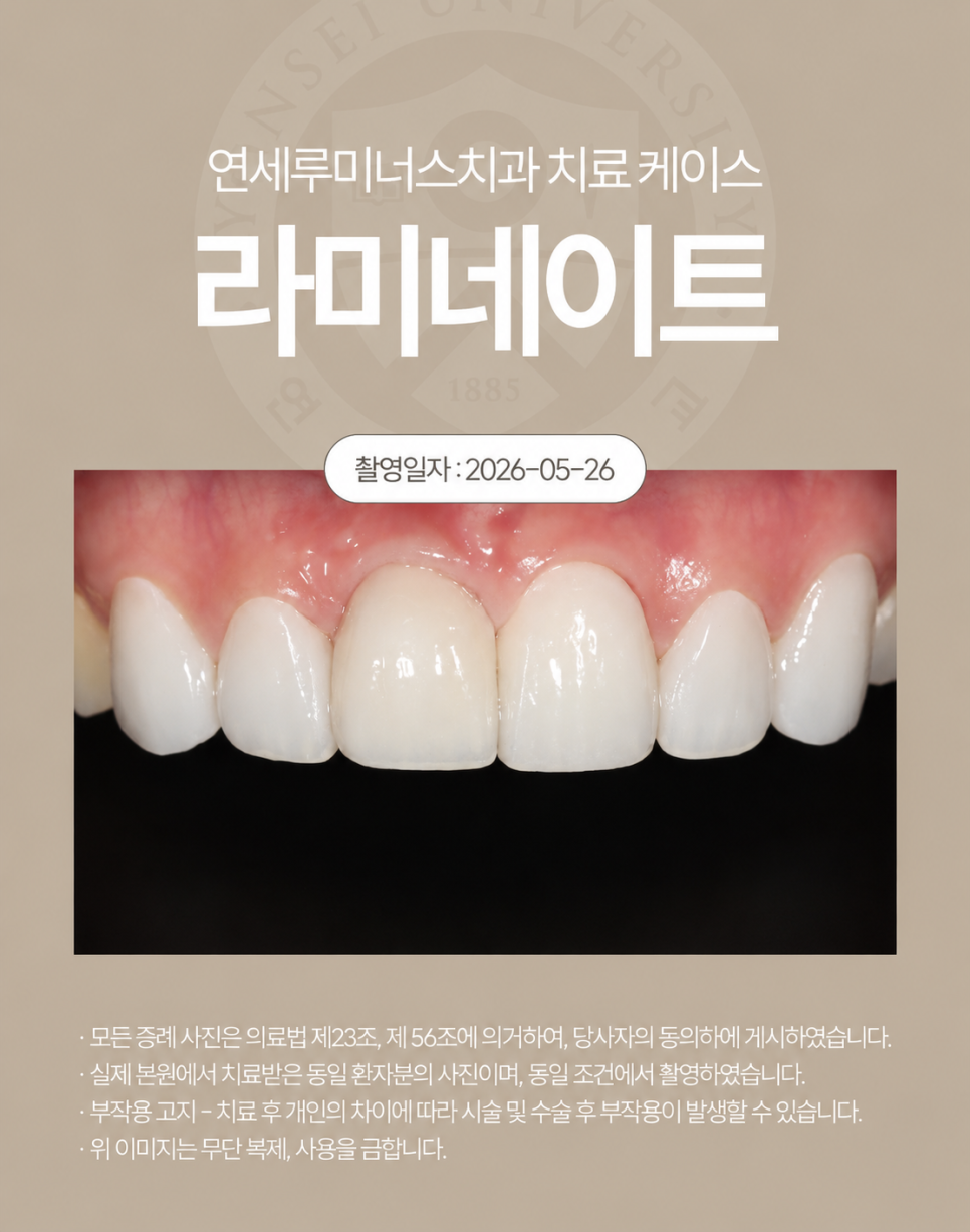 강남라미네이트 치료사례 - 색상, 라인개선 (30세/여) 관련 이미지 4