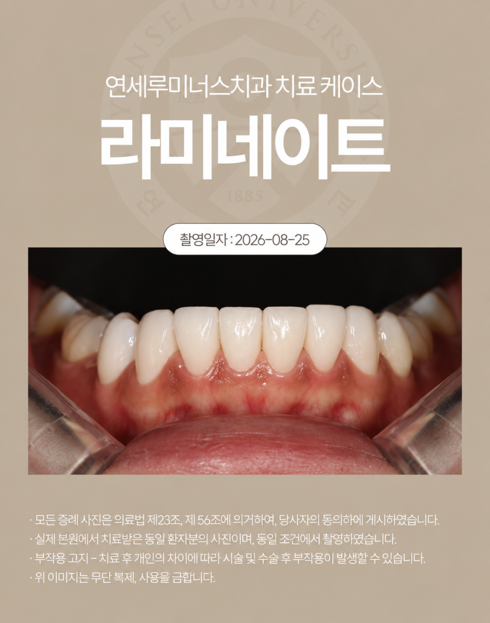 강남라미네이트 / 치아의 손상은 줄이고, 자연스러움은 더하는 방법 관련 이미지 5