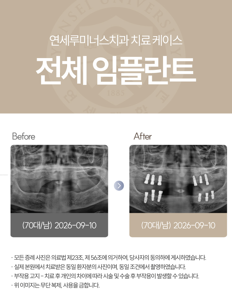 강남전체임플란트 케이스 : 제주도에서 찾아오신 무치악 환자, 당일 식립 완료 관련 이미지 1