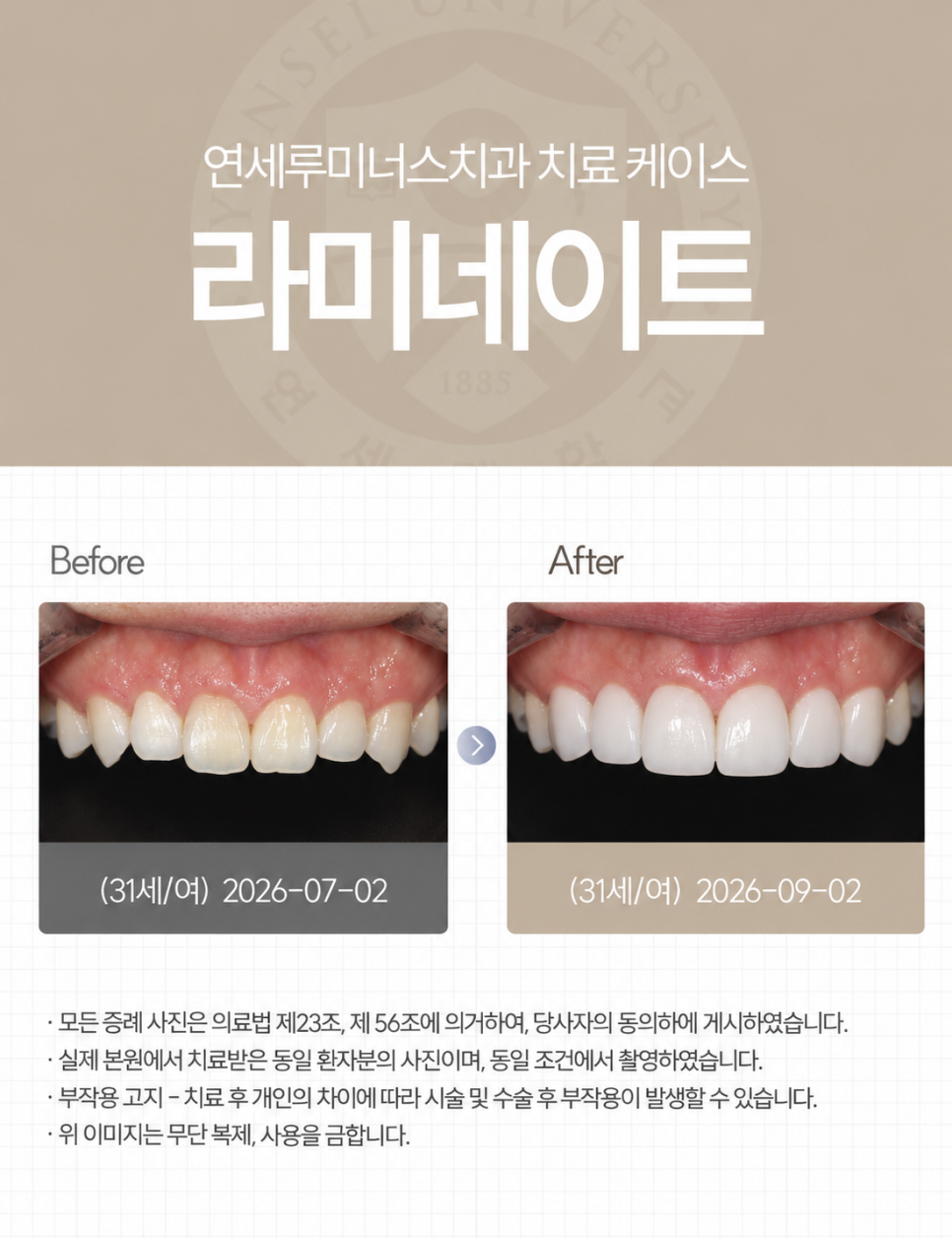강남라미네이트 / 치아의 작은 디테일까지 고려한 심미 라미네이트 관련 이미지 1