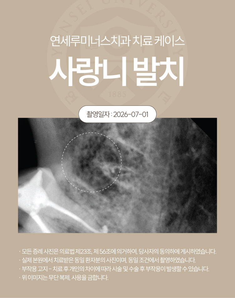 Gangnam Station Wisdom Tooth Extraction Case ― Simultaneous Extraction of Three Wisdom Teeth (21-Year-Old Female Patient) image 6